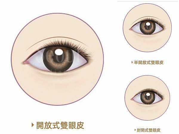 双眼皮纪录 (1).jpg