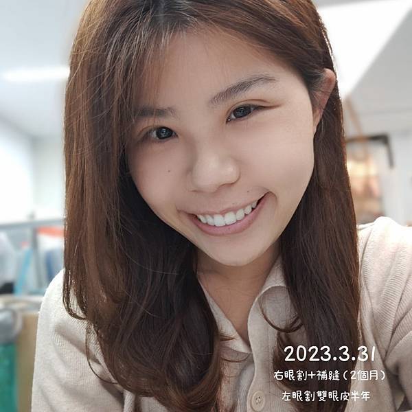 割双眼皮半年记录 (1).jpg
