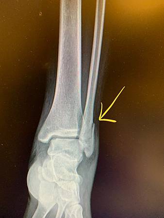 常見的腳踝腓骨骨折與開刀治療過程滑板骨折 Viviの冒險旅程 痞客邦