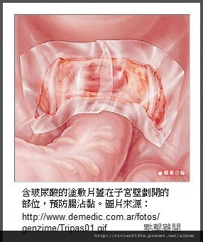 剖腹產前ㄉ認知 婦科手術預防沾黏 Seprafilm 玻尿酸的運用 極品倫和寶貝潔ㄉ甜蜜窩 痞客邦