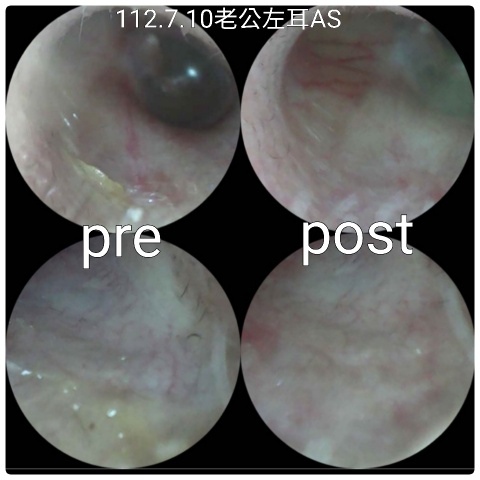 112.07.10#台南悅耳_新式釆耳 #掏耳 #采耳_耳道