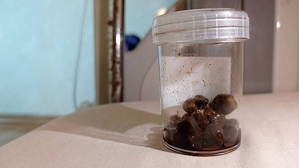 【膽結石】20210616 終於等到開刀切除膽囊啦