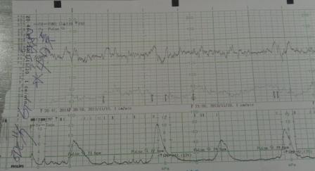 測胎心音1