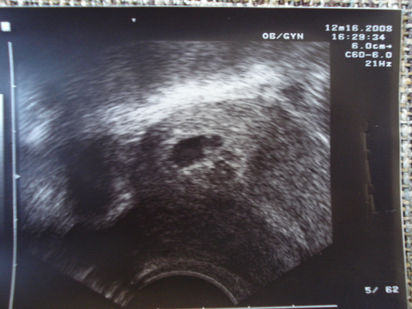 發現&證實~牛小勁的到來(2008.12.16)~牛小勁約5週4D....其實12.10號出血時，醫生就說子宮裡有一個0.3cm的小水泡，應該是懷孕，我堅持說沒有，因為mc 11/26~29才來過啊~