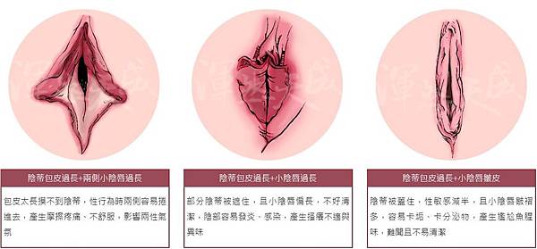 小陰唇陰蒂包皮過長肥厚01.JPG