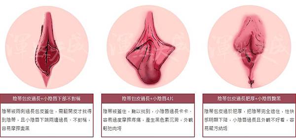 小陰唇陰蒂包皮過長肥厚04.JPG