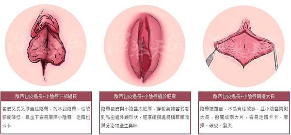 有照片 如何知道妳有小陰唇過長肥大 各式各樣小陰唇 渾然天成整形醫美 痞客邦