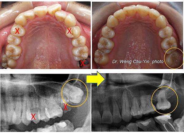缺牙病例 矯正立正智齒 關閉大臼齒空隙 矯正專科翁竹音醫師 矯正專科 翁竹音醫師 痞客邦