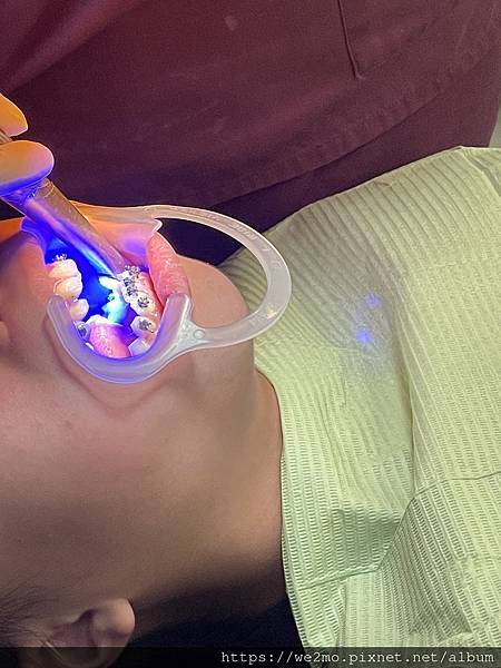 【基隆小六牙齒矯正】基隆兒童矯正牙齒費用、 矯正牙齒過程紀錄