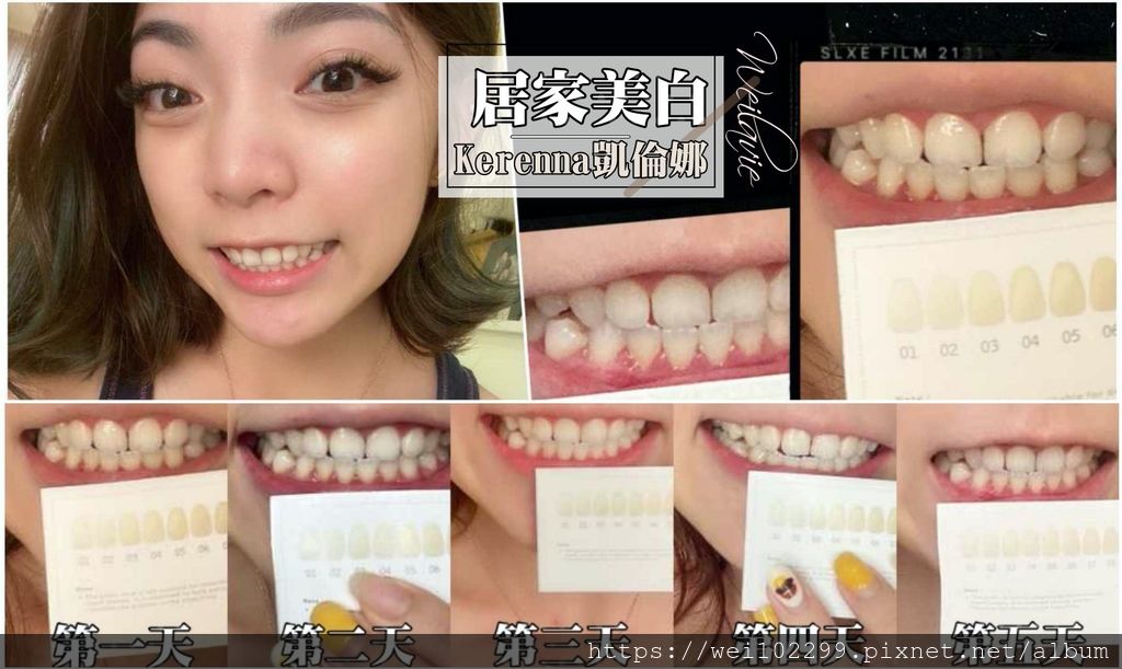 1最簡易的居家美白牙齒商品心得分享!平價卻最不傷牙的凱倫娜牙齒美白組─居家冷光美白機|Kerenna 凱倫娜牙齒美白專科2.jpg 1最簡易的居家美白牙齒商品心得分享!平價卻最不傷牙的凱倫娜牙齒美白組─居家冷光美白機|Kerenna 凱倫娜牙齒美白專科2.jpg