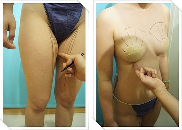 桃園自體脂肪隆乳推薦 桃園自體脂肪隆乳推薦
