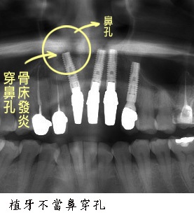 0804植牙新聞圖5.jpg