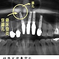 0804植牙新聞圖5.jpg