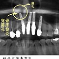 0810植牙新聞圖3.jpg