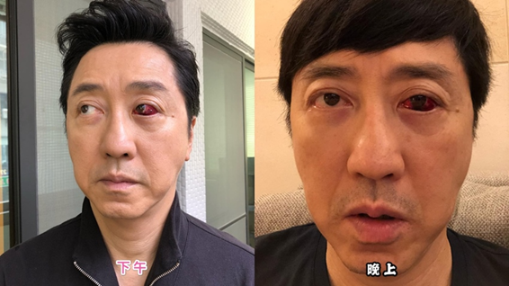 。 眼白爆血管【庾澄慶】親身經歷【快速消血塊】