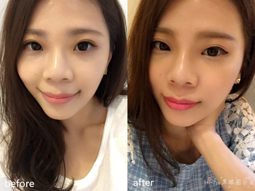 ✿南西尚安醫美診所✿再多一點點會更美… 玻尿酸美鼻新體驗…