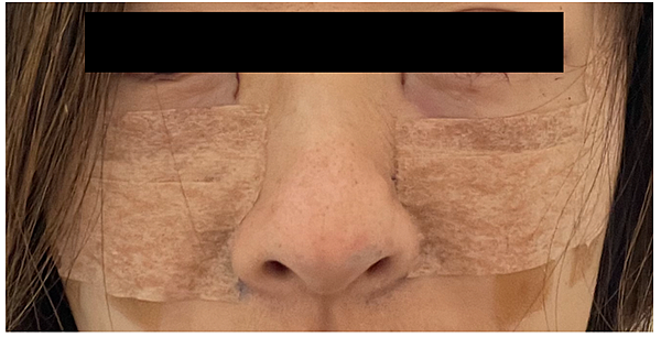 眼袋移位手術+臉部補脂手術分享 (下)