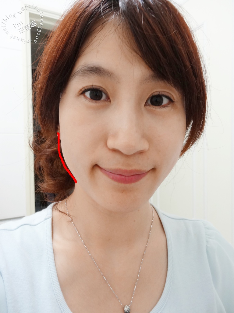 悠美診所肉毒小臉_20 悠美診所肉毒小臉_20
