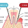 微創牙周雷射_9.jpg