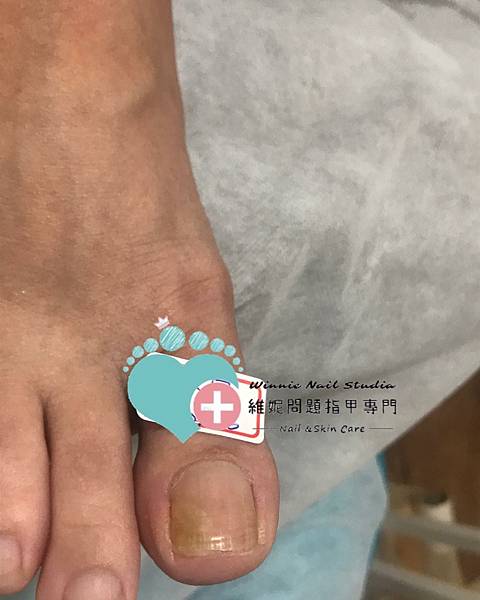 156242706_386447甲溝炎 捲甲 嵌甲 凍甲 指甲差到肉 灰指甲 黴菌 雞眼 硬皮厚繭 無痛清1950240373_6302611687572369527_n