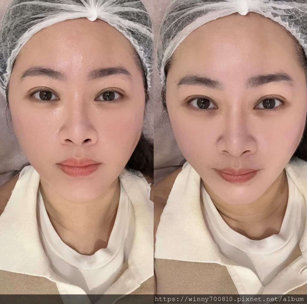 新竹杏芙診所｜無針水光 SEYO敏弱肌也能安心做的保濕療程！