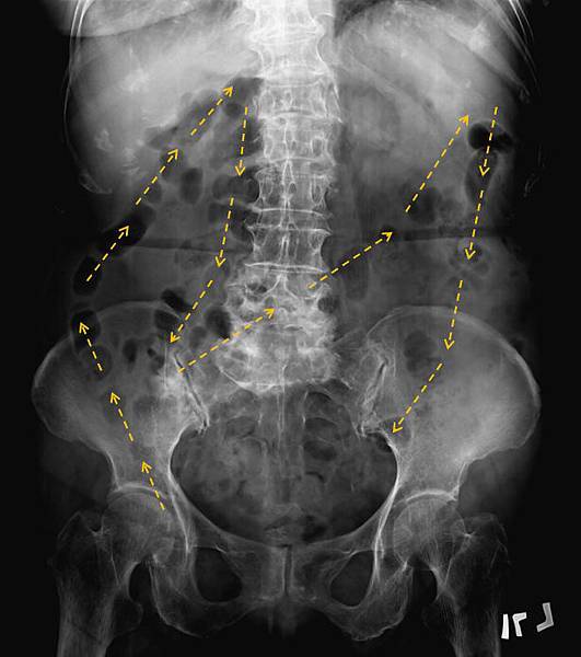 KUB renal stone 4