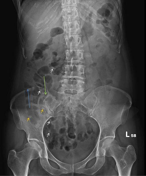 Diverticulitis 5