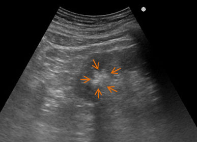 Rt flank pain renal stone