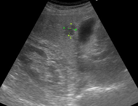 37645377 LIVER ABSCESS3