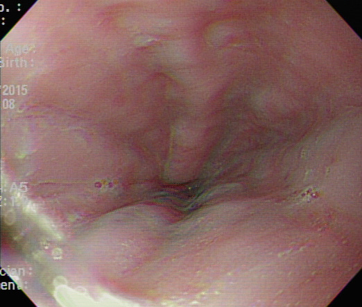 35104202ENDO esophagus