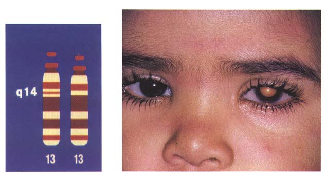 Retinoblastoma cancer