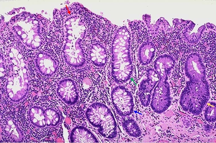 Polyp pathology