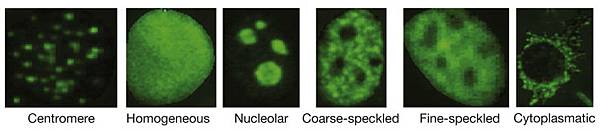 antinuclear antibody