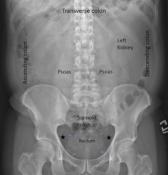 Pelvis soft tissue2