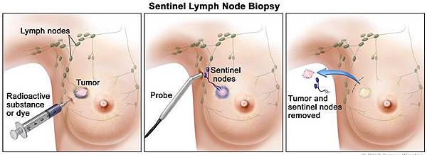 Sentinel lymph node
