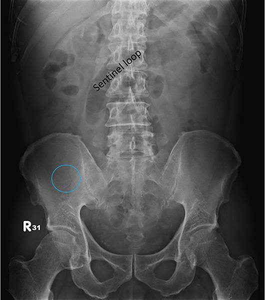7415987 sentinel loop