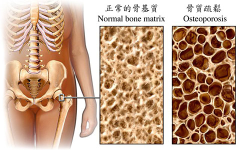 bone-osteoporosis