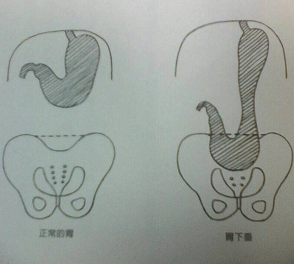 胃下垂圖 胃下垂圖