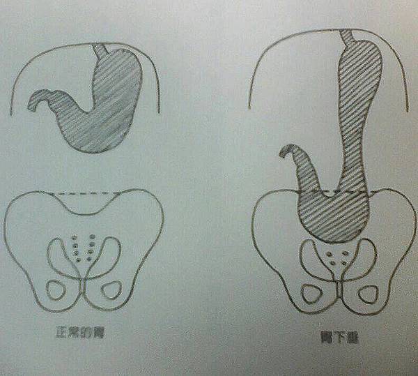 胃下垂圖