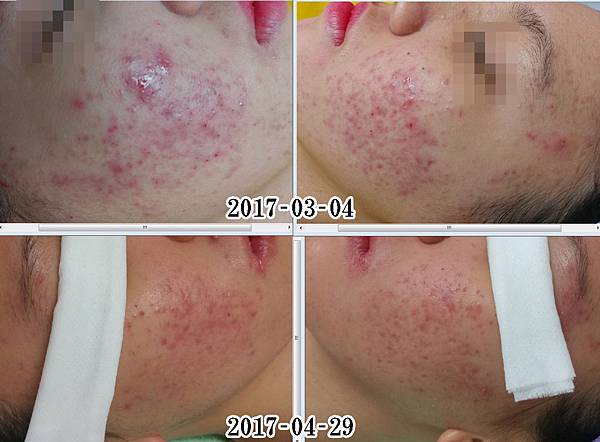 粉刺種類9 6 珍珠型粉刺 引發丘疹痘痘的案例 台東心怡美顏館0 林季儀老師 心怡美顏館 Je無痛清粉刺 美容師必學的針對技術 Je林季儀老師