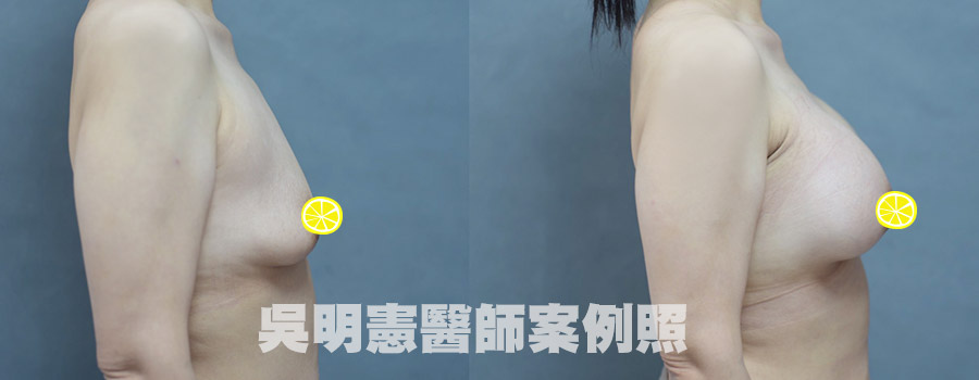 【台中隆乳推薦】還在猶豫隆乳材質？來看女王波與魔滴的案例照，找對醫師讓你對隆乳更有信心！｜台中吳明憲醫師