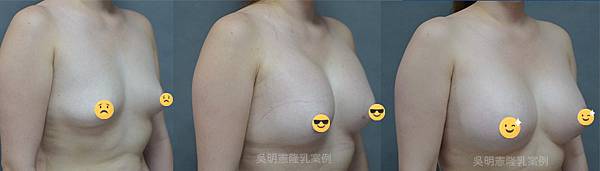 吳明憲醫師案例照-女王波隆乳手術(側45°)：術前、術後三個月、術後六個月