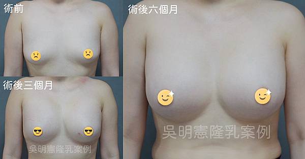 吳明憲醫師案例照-女王波隆乳手術(正面)：術前、術後三個月、術後六個月