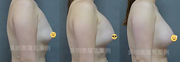 吳明憲醫師案例照-女王波隆乳手術(側面)：術前、術後三個月、術後六個月