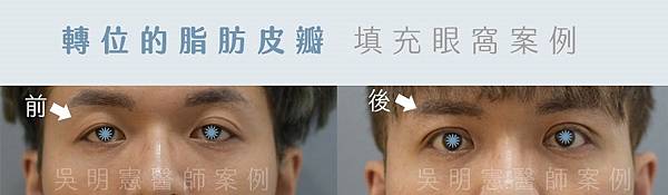 誠美學吳明憲醫師案例照－真皮脂肪塊狀移植