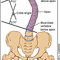 脊椎側彎 cobb angle.gif