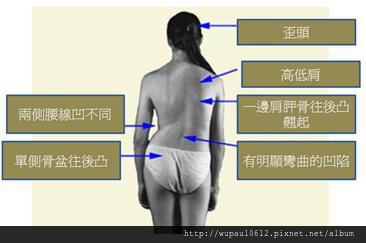 側彎體態 側彎體態