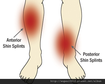 Shin-splints.jpg