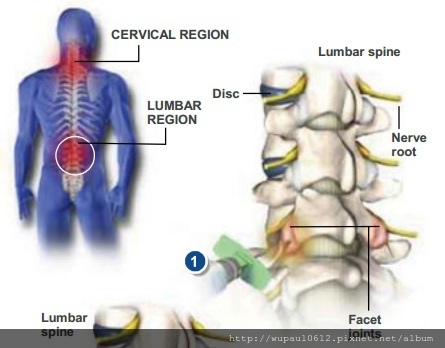 facet_joint_injections.jpg