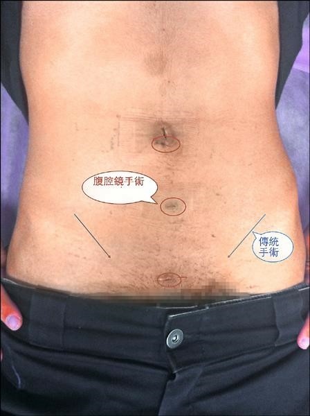inguinal henria.jpg inguinal henria.jpg